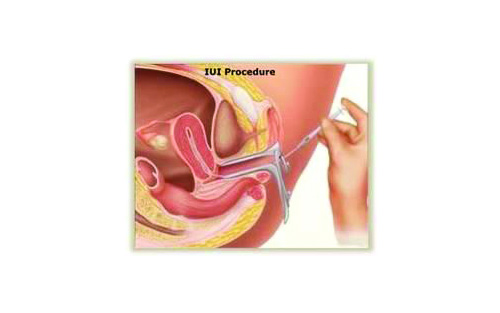 'IUI’ ความหวังแห่งชีวิตใหม่ ที่ปลอดภัยและได้ผลดี