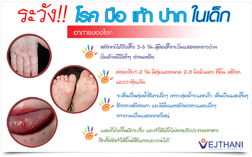 โรคมือเท้าปาก