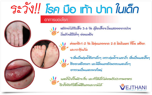 ระวัง มือ เท้า ปาก ในเด็กหากรักษาไม่ทันอาจตายได้