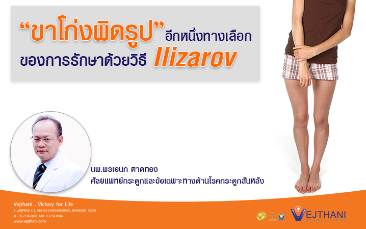 ขาโก่งผิดรูป...อีกหนึ่งทางเลือกของการรักษาด้วยวิธี Ilizarov