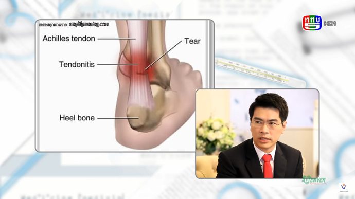เอ็นร้อยหวายอักเสบ | นพ. กฤษฎิ์ พฤกษะวัน ศัลยแพทย์กระดูกและข้อ (เท้า - ข้อเท้า)