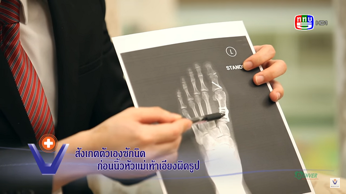 สังเกตตัวเองซักนิด ก่อนนิ้วหัวแม่เท้าเอียงผิดรูป | นพ. กฤษฎิ์ พฤกษะวัน
